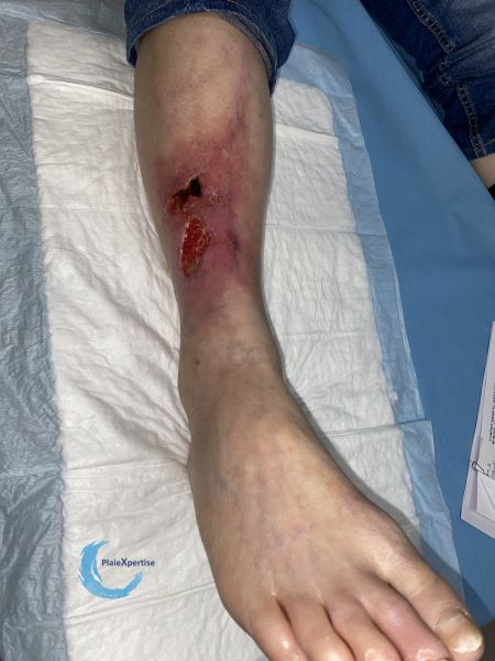 Fichier:Angiodermite typique119.jpg