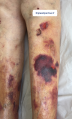 Dermatoporose9.png