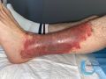 Eczéma111.jpg