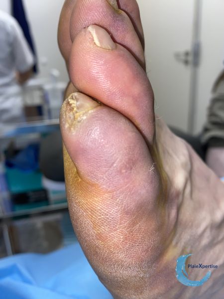 Fichier:Embols de cristaux de cholestérol12.jpg