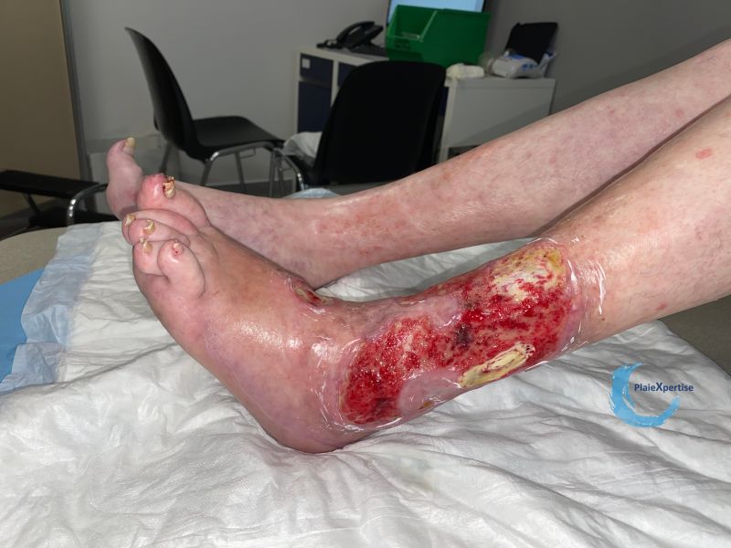 Fichier:Tendon normal45.jpg
