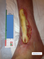 Tendon normal7.png