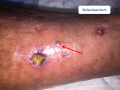 Pustules3.png
