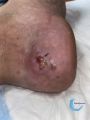 Calcifications40.jpg