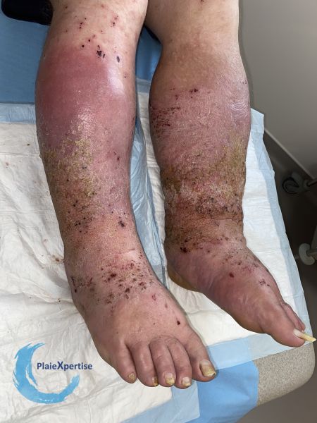 Fichier:Grosses jambes suintantes49.jpg
