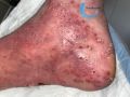 Pustules15.jpg