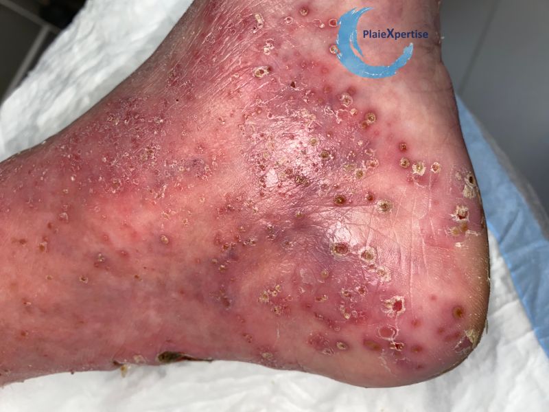 Fichier:Pustules15.jpg