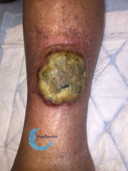 Fichier:Pyoderma gangrenosum29.jpg