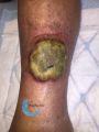 Pyoderma gangrenosum29.jpg