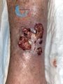 Pyoderma gangrenosum34.jpg