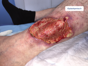 Tendon-Voussure6.png