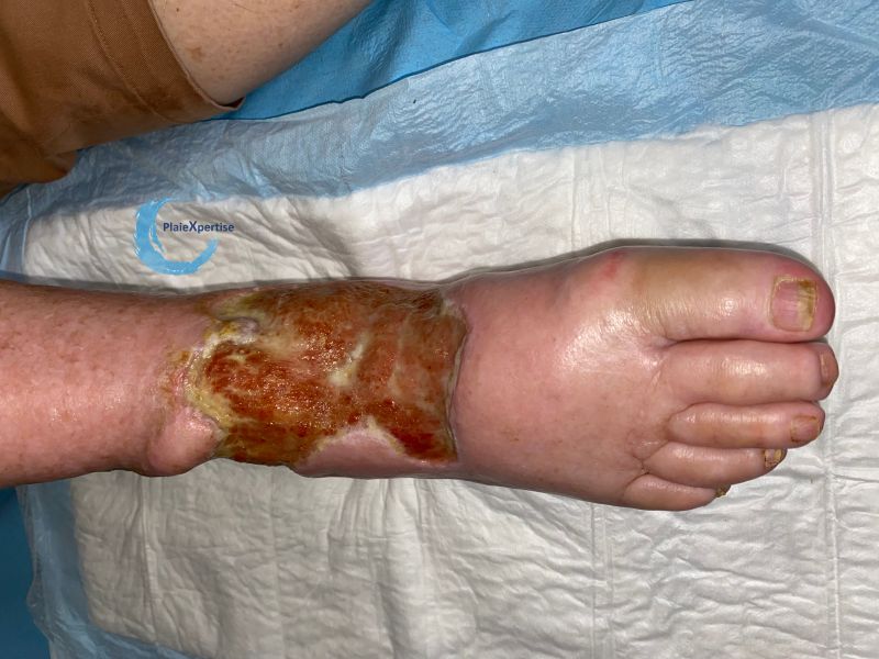 Fichier:Cou de pied85.jpg