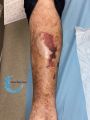 Dermatoporose45.jpg