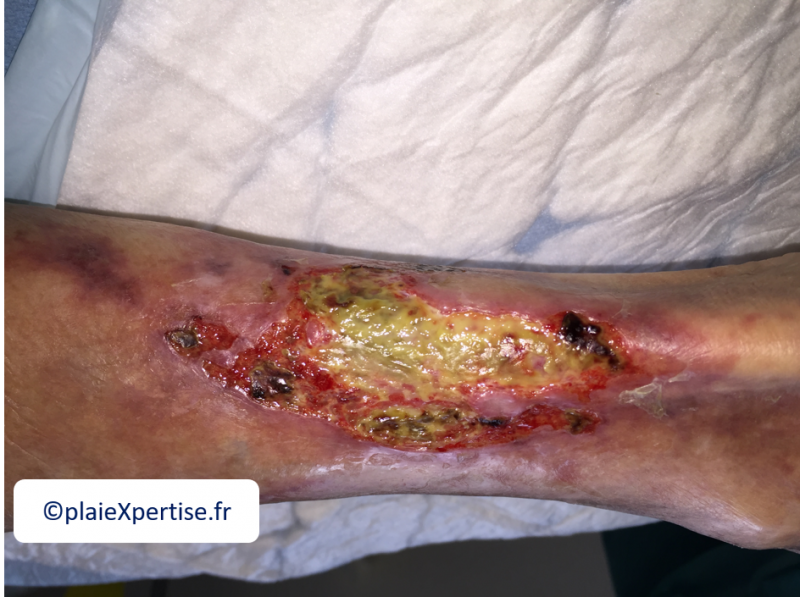 Fichier:Angiodermite atypique9.png