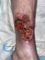 Angiodermite typique93.jpg