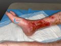 Dermite d'irritation185.jpg