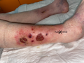 Tissu de granulation inflammatoire22.png
