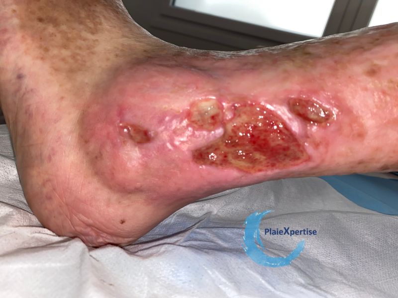 Fichier:Tissu de granulation inflammatoire39.jpg