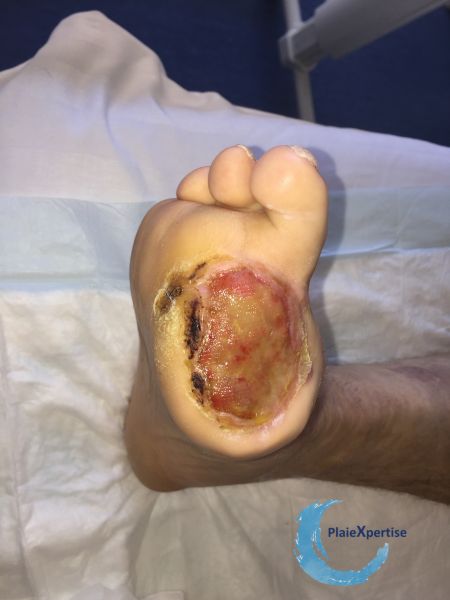 Fichier:Amputation30.jpg