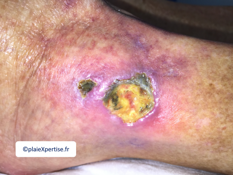 Fichier:Angiodermite typique5.png