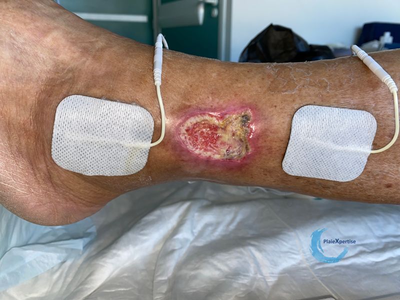Fichier:Angiodermite typique121.jpg