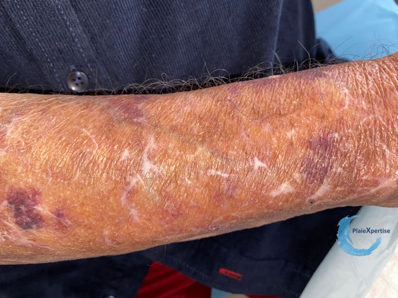 Fichier:Dermatoporose51.jpg