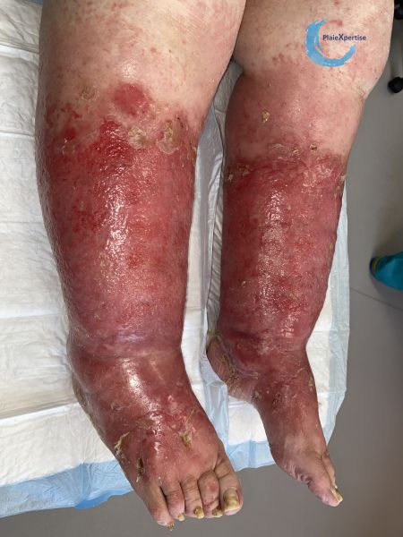 Fichier:Dermite d'irritation181.jpg