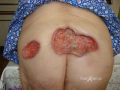 Lymphome cutané ulcéré4.png