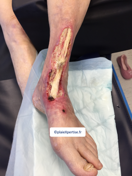 Fichier:Tendon normal11.png