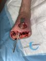 Amputation7.jpg