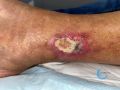 Angiodermite typique120.jpg