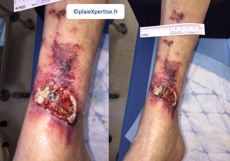 Fichier:Angiodermite typique7.png