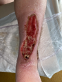 Tendon-Reliquat18.png