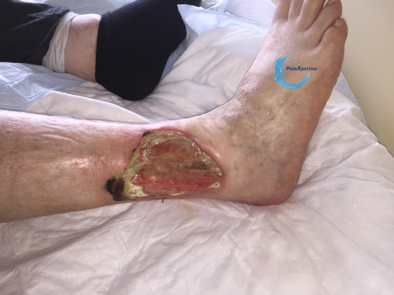 Fichier:Angiodermite typique60.png