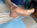 Pied de Charcot46.jpg