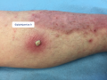 Pustules8.png