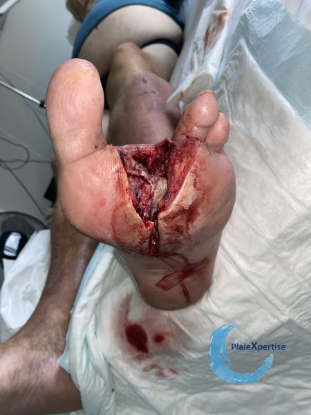 Fichier:Amputation9.jpg
