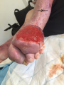 Lymphoedème pied17.png