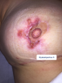 Pyoderma gangrenosum11.png