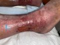 Dermite d'irritation172.jpg