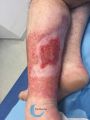 Epidermisation6.jpg