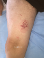 Herpes et zona2.png