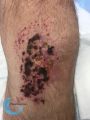 Pyoderma gangrenosum51.jpg