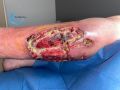 Pyoderma gangrenosum68.jpg