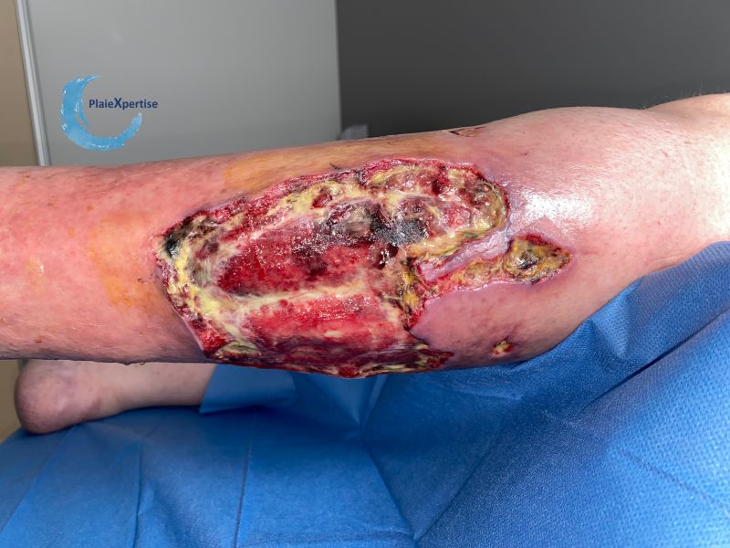 Fichier:Pyoderma gangrenosum68.jpg