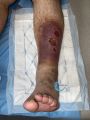Hypodermite chronique53.jpg