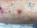 Pustules13.jpg