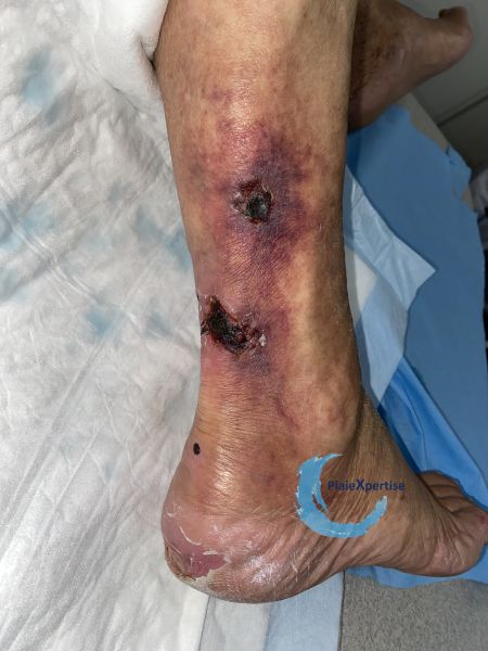 Fichier:Angiodermite typique69.jpg