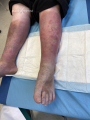 Dermiteocre39.png