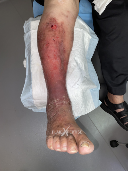 Fichier:Eczéma67.png